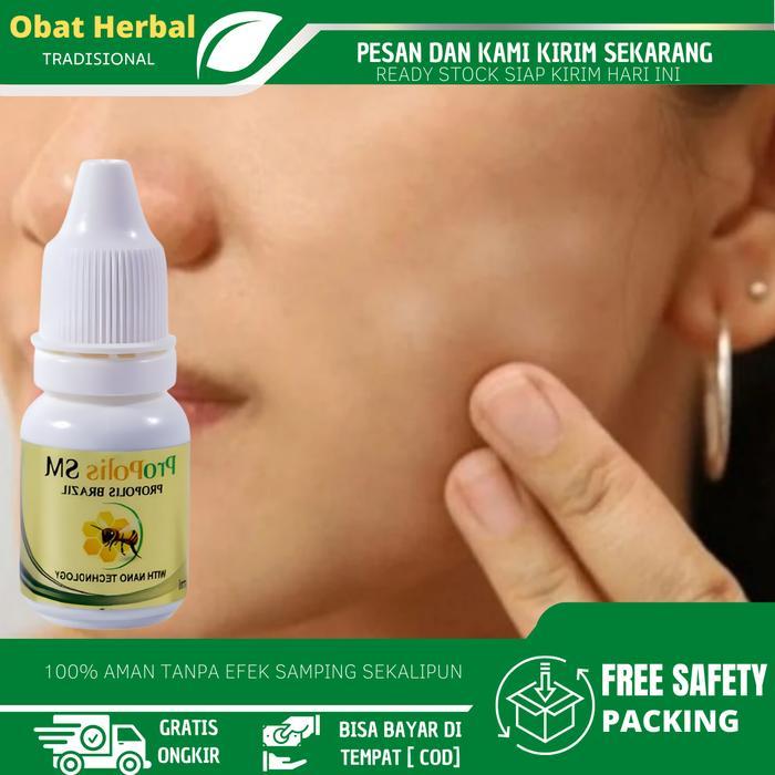 Cairan Oles Perawatan Panu Di Wajah, Bercak Putih Di Wajah, Penghilang Panu, Kulit Wajah Belang,