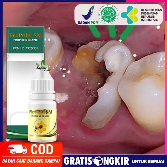 Obat Perontok Karang Gigi, Obat Pemusnah Karang Gigi - Gigi Berlubang Pasti Promo