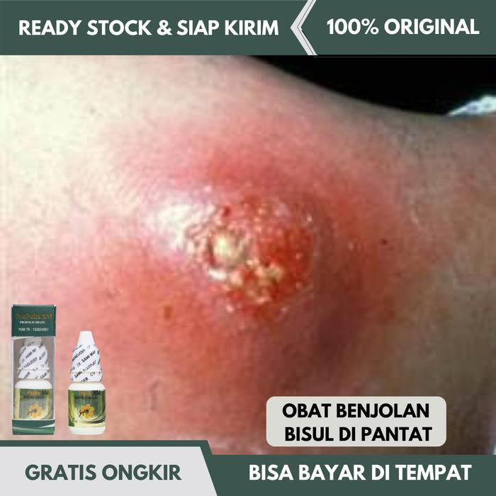 Obat Benjolan di Pantat, Bisul di Pantat, Salep Bisul Bernanah