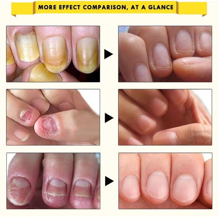 Oedo Minyak Essence Pelembab Kuku Kaki 10Ml Untuk Menghilangkan