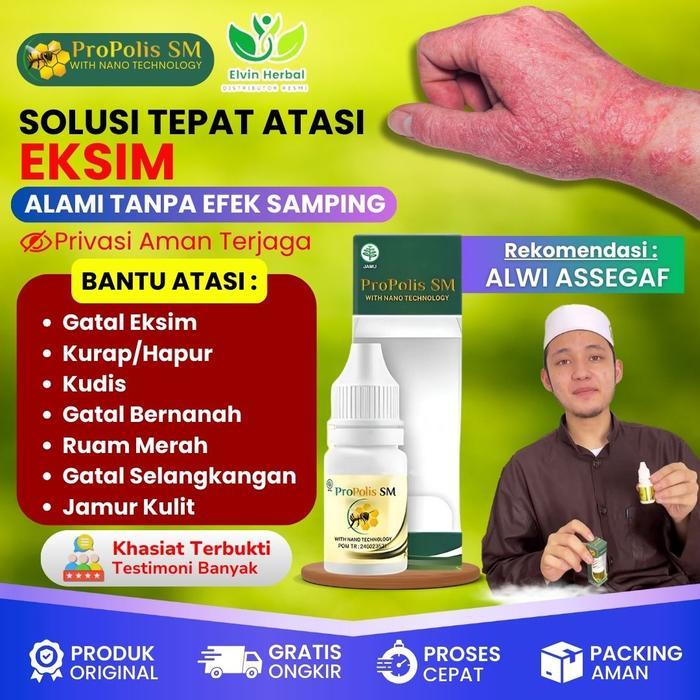 Propolis SM - Eksim Kering Menahun, Eksim Kering, Eksim Basah, Gatal Eksim, Eksim Menahun, Gatal