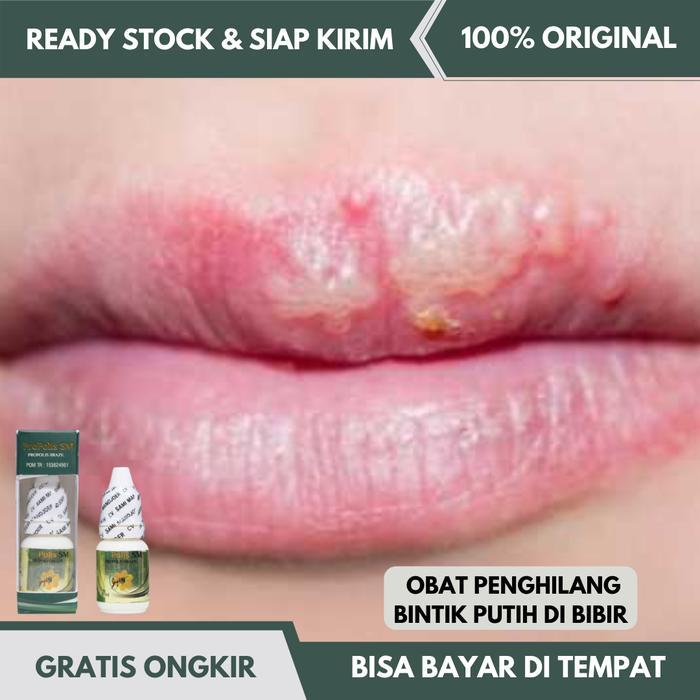 Obat Bintik Putih di Bibir, Penghilang Bintik Putih di Bibir, Sariawan
