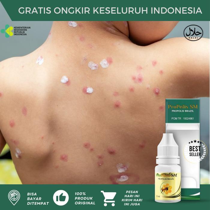 DISKON Propolis SM Obat Salep Cacar Air Anak Dan Dewasa, Penghilang Bekas Luka Cacar Lama, Cacar Air