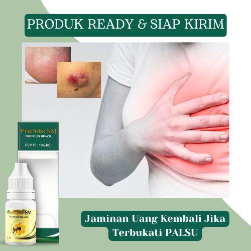 Cairan Oles Untuk Abses Payudara, Pengempis Benjolan Bernanah Pada Payudara, Mastitis, Payudara Beng