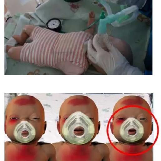 Infant T Piece system/balon tak mengembang sendiri
