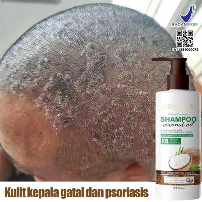 Shampoo Anti Ketombe Dan Gatal Penghilang Ketombe Shampo Psoriasis Kulit Kepala Obat Ketombe