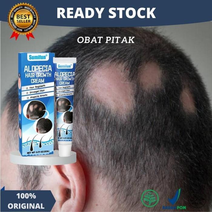 Sale [Ready Stock]Obat Alopecia Areata, Menumbuhkan Penumbuh Rambut Cepat Obat, Penumbuh Rambut