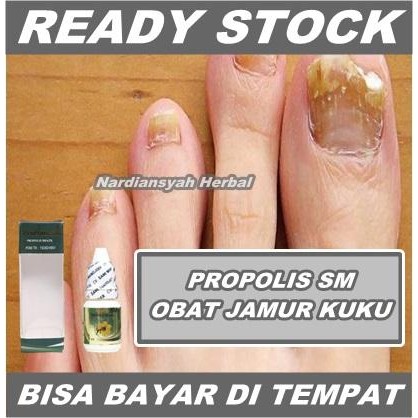 Sale Obat Jamur Kuku, Infeksi Jamur Kuku, Salep Jamur Kuku di Tangan & Kaki Terlaris