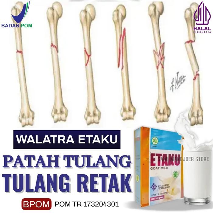 eoug- Susu Patah Tulang, Tulang Retak, Susu Kalsium Tulang - Walatra Etaku