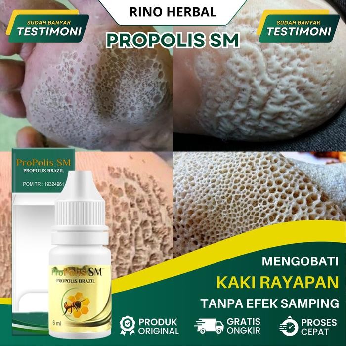 Pilihan- Propolis Sm Untuk Telapak Kaki Rayapan, Kaki Rayapan, Telapak Kaki Bolong Bolong, Kaki