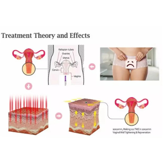 TERMURAH New Female Vaginal Tightening Laser for Female Vaginal Lifting and Rejuvenation Treatment