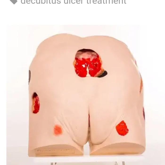 Manekin Decubitus Model Simulator Perawatan Luka Ulkus Dekubitus Seymour II Wound Care