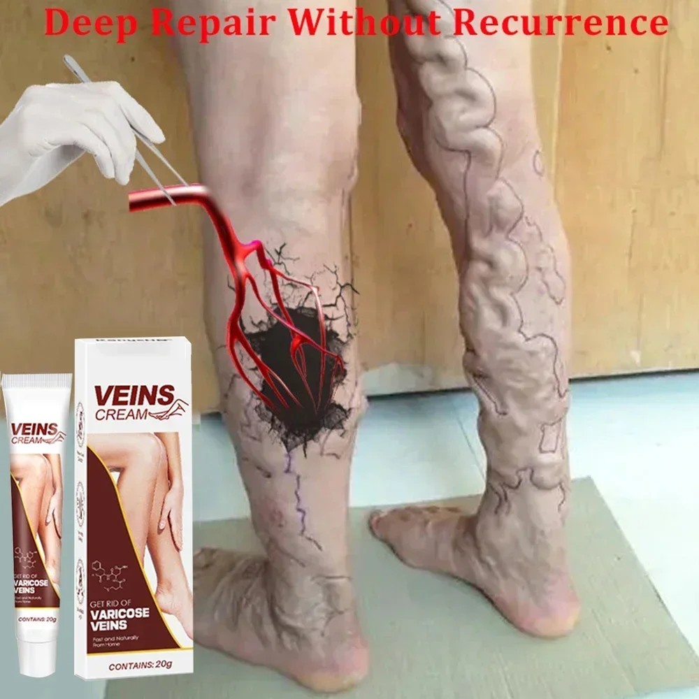 Effective Varicose Vein Relief Cream Eliminate Vasculitis Phlebitis Spider Legs Treatment Soothing