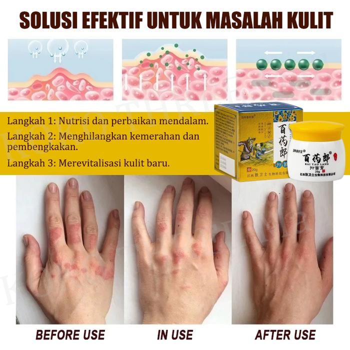 Salep Gatal China Paling Ampuh Salep Gatal Jamur Selangkanga Krim Eksim Bayi Dan Anak Obat Gatal