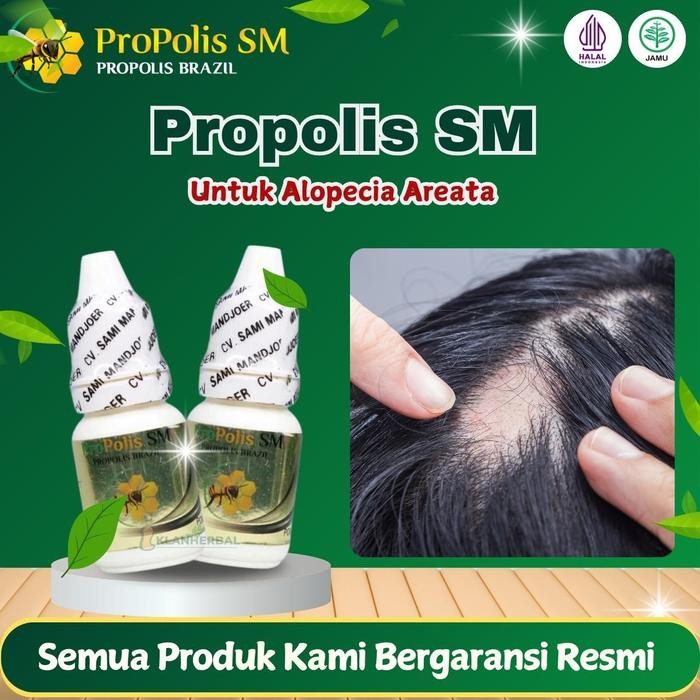 Pilihan- Perawatan Untuk Alopecia Areata, Rambut Pitak, Penumbuh Rambut Rontok , Psoriasis