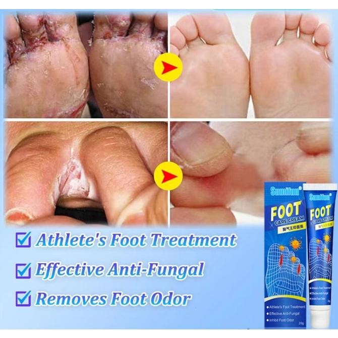 Obat Telapak Kaki Rayapan, Obat Kaki Rayapan, Obat Telapak Kaki Bolong Bolong, Salep Kaki Rayapan