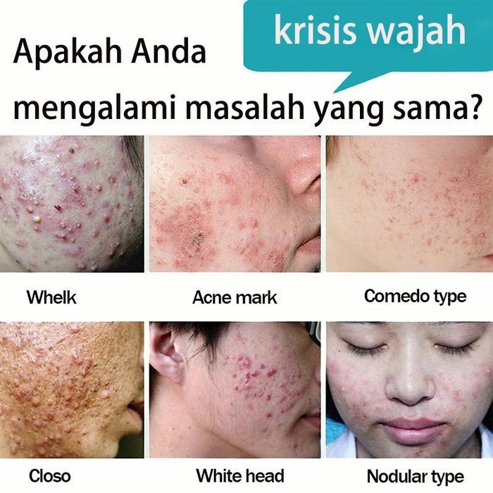 15% Azelaic Acid Krim Jerawat/Krim Bintik Pemutih/Obat Jerawat Ampuh/Salep Pembersih
