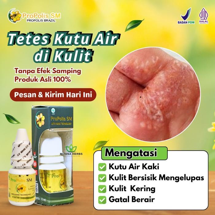 Pilihan- Obat Tetes Kutu Air Di Kaki Tangan Sela Jari Luka Bernanah Dan Bengkak Borok Budug