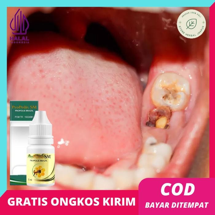 Pilihan- Obat Pencabut Gigi Berlubang Perontok Gigi Sampai Akar Penghancur Gigi Berlubang Cepat