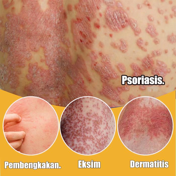 Promo Salap Gatal Kulit Yang Ampuh Salep China Untuk Gatal Gatal Obat Gatal Selangkangan Dan Hitam