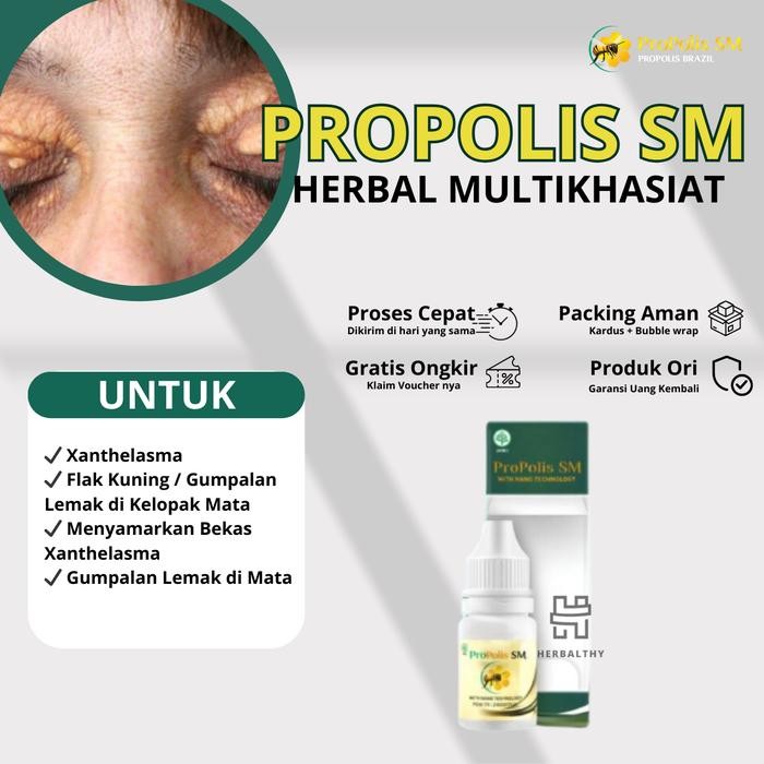 Propolis Sm Xanthelasma Penghilang Milia Bintik Di Dekat Mata, Milea Di Wajah, Salep Xanthelasma,