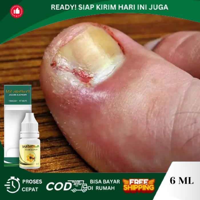 Sale Tetes Cantengan Jempol Kaki, Kuku Jempol Nyeri Bau Busuk, Jempol Kaki Bengkak Bernanah, Kuku