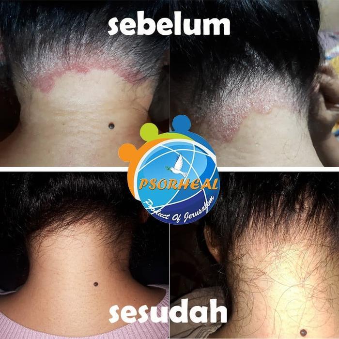 Paket Cream Tanpa Shampo Ketombe Parah Psoriasis Scalp Psorheal Israel Terbaruu!!