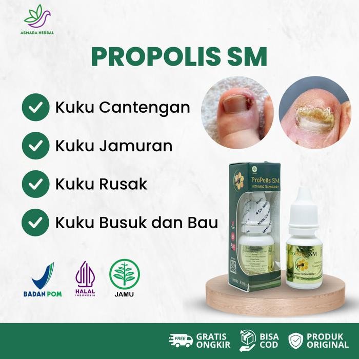 Sale Propolis SM Obat Kuku Cantengan Jempol Kaki dan Tangan, Kuku Jamuran, Kuku Hitam Kering, Kuku