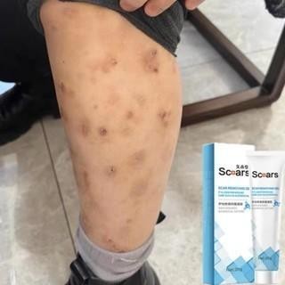 Penghilang Bekas Luka Lama Menghitam Salep Koreng Budukan Paling Ampuh Anak Dewasa Bekas Gigit