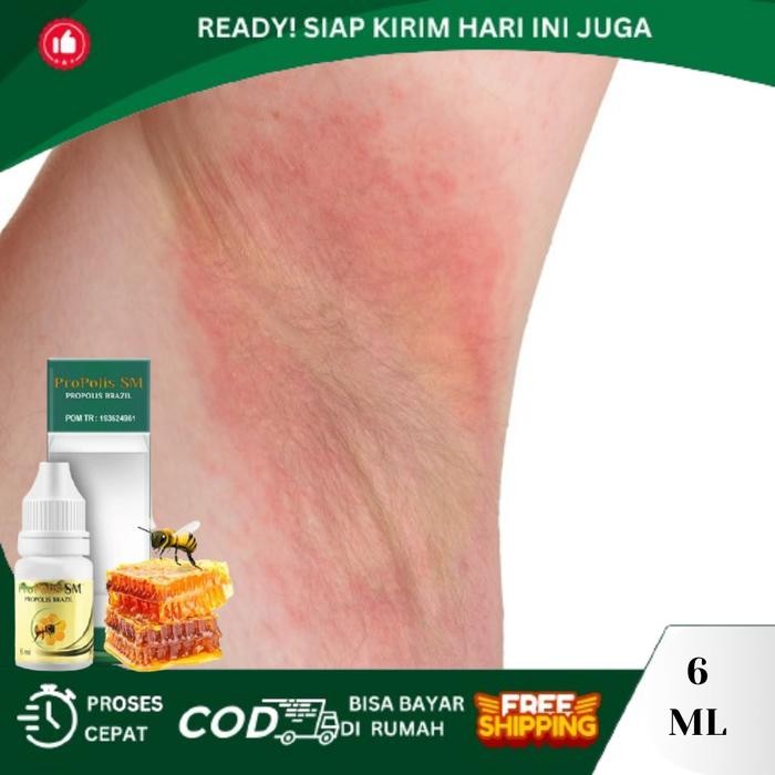 Iritasi Pada Ketiak, Ketiak Gatal, Ketiak Lecet Dan Perih, Gatal Merah Pada Ketiak, Ketiak Berjamur