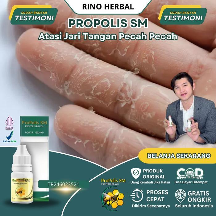 NEW PRODUK SALEP JARI TANGAN PECAH PECAH, JARI TANGAN KERING, JARI TANGAN KERING DAN PECAH, KULIT