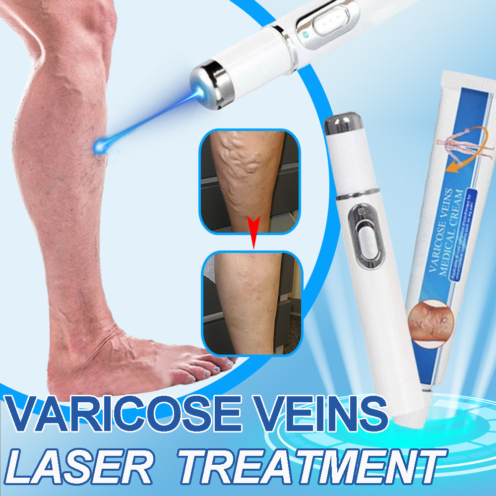 Varicose Veins Remove Laser Therapy Spider Veins Removal Ointment Vasculitis Phlebitis Phlebitis Leg