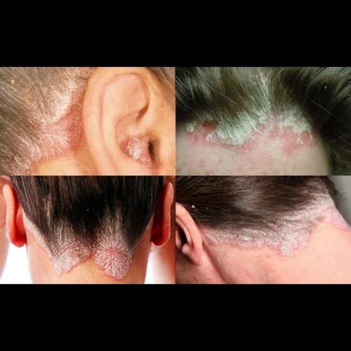 KirimInstan- Ramuan Sinshe Obat Cina Psoriasis Kulit Kepala Dan Obat Eksim