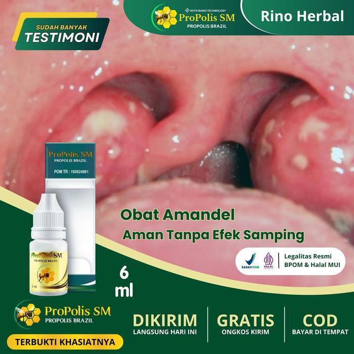 OBAT HERBAL AMANDEL MENGEMPESKAN AMANDEL BENGKAK RANDANG AMANDEL AMANDEL SAKIT UNTUK ANAK DEWASA