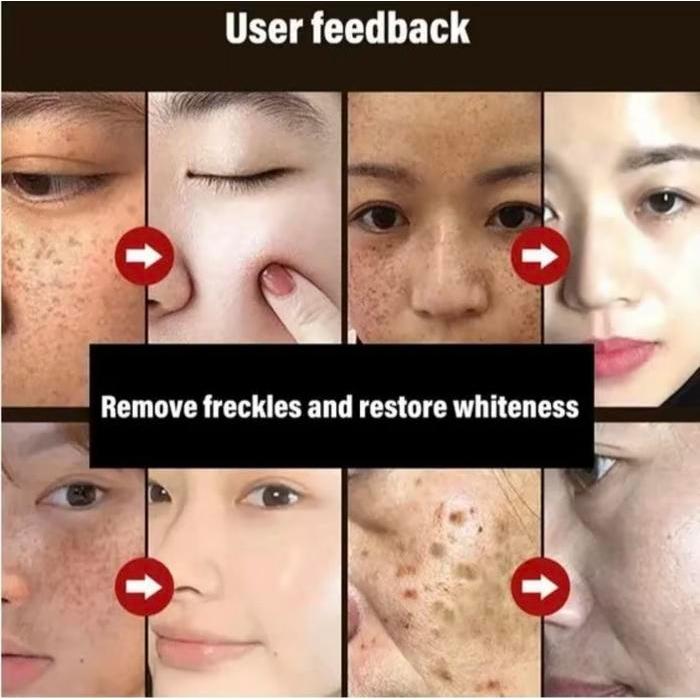 MEETFACE Masker Wajah Menghilangkan Bintik-Bintik Topeng Koyak Anti Penuaan & Kedut Kolagen 100%