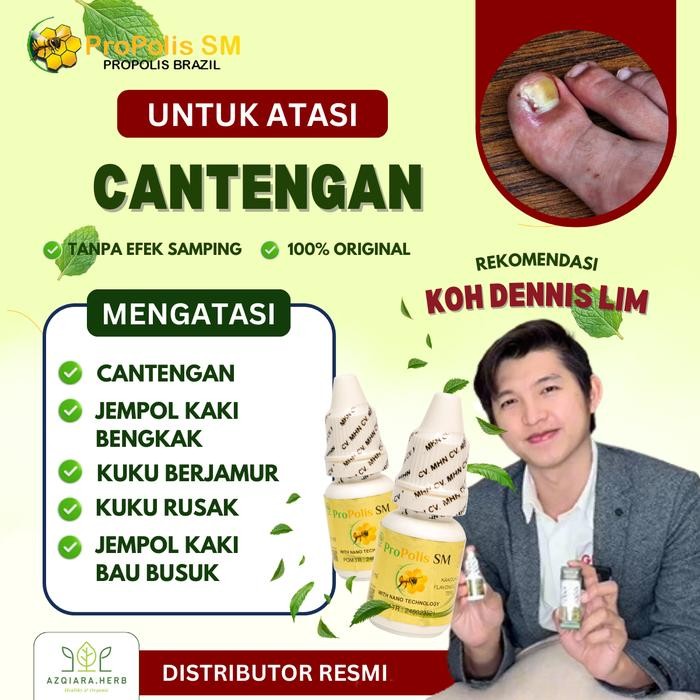 Sale Propolis Sm Tetes Kaki Cantengan, Cantengan Bernanah, Cantengan Di Jempol Kaki, Tetes Jempol