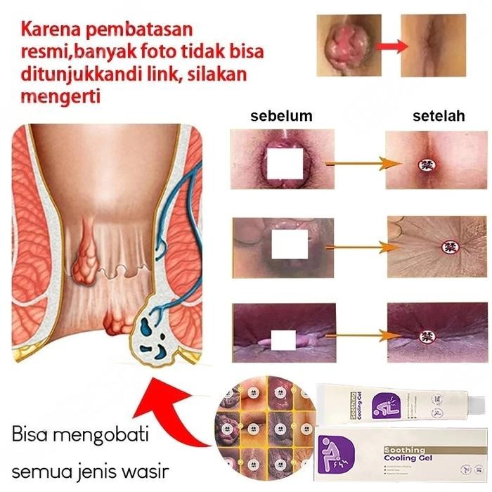 Obat Wasir Salep Wasir Original Soothing Cooling Gel Salep Ambeien Paling Ampuh Obat Hemoroid Herbal