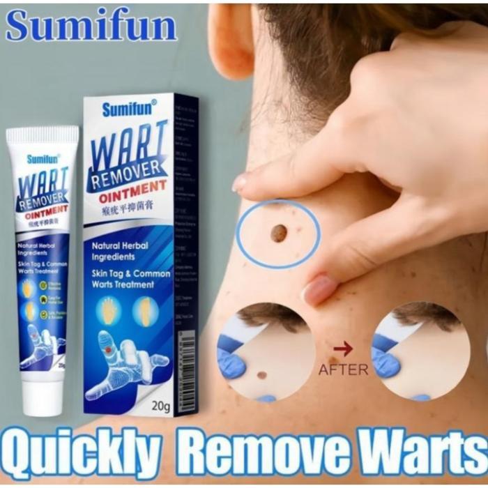 Baru Sumifun Wart Remover Penghilang Tahi Lalat