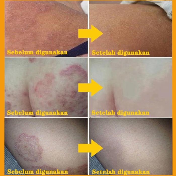 Salep Gatal Salep Eksim Salep Gatal Selangkangan 20G Salep Gatal Jamur Selangkangan Salep Obat Gatal