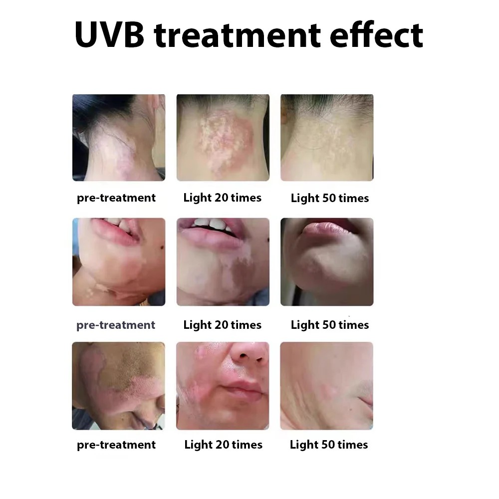 311nm Ultraviolet Phototherapy Instrument Double Lamp UVB Lamp for Vitiligo Treatment Psoriasis Lamp