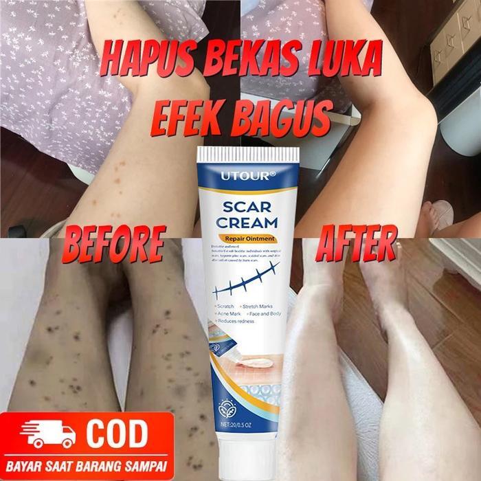 Krim Penghilang Bekas Luka Penghilang Bekas Luka Hitam Koreng Penghilang Bekas Luka Di Kaki