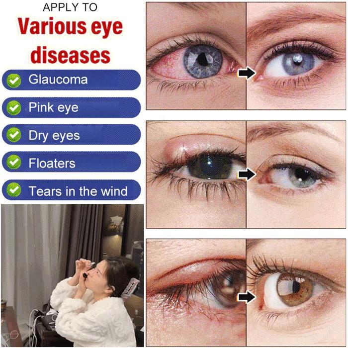 5s79- Khusus Untuk KatarakSpray Tetes Mata Untuk Katarak Spray Mata Rabun Cuci Mata Tetes