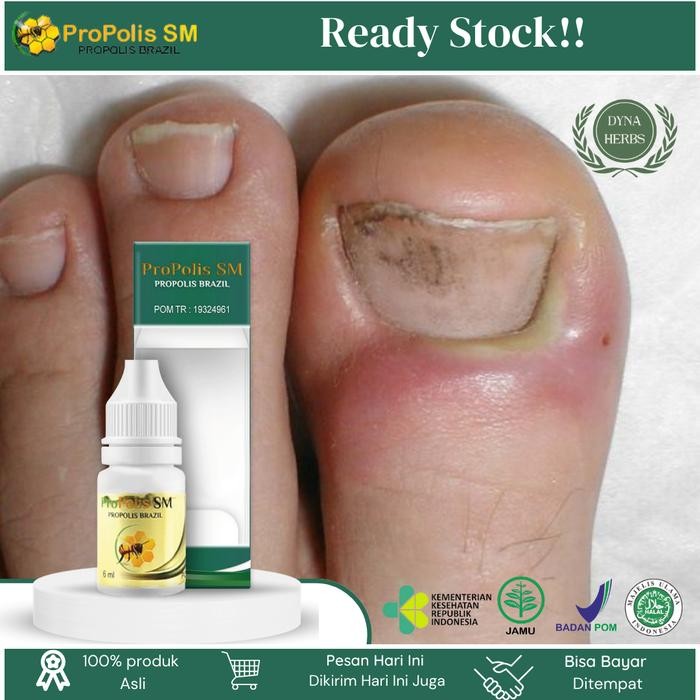 Khusus Grab Tetes Cantengan Jempol Kaki, Kuku Jempol Nyeri Bau Busuk, Jempol Kaki Bengkak Bernanah,