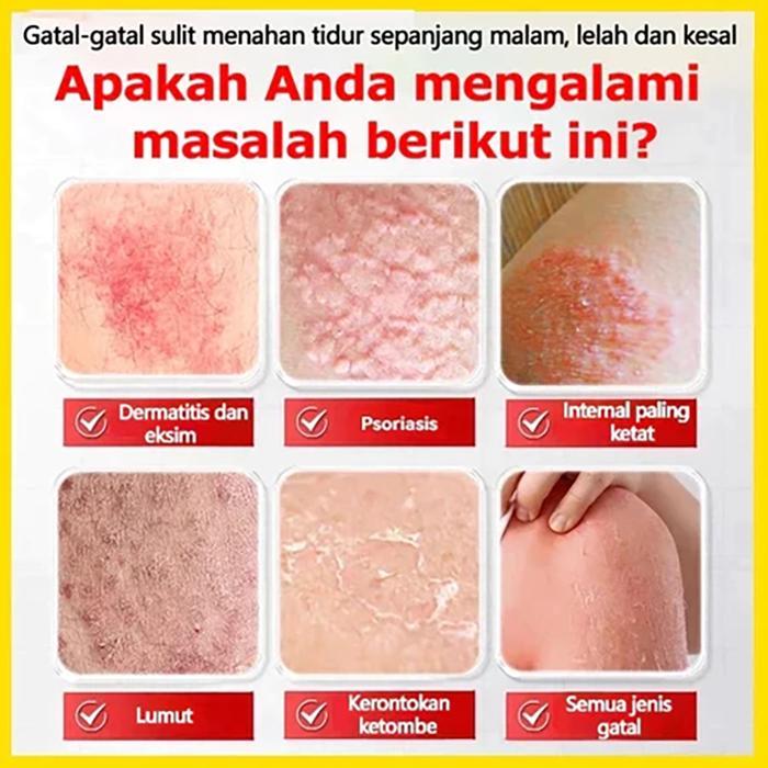 Salep Gatal China Paling Ampuh Salep Gatal Jamur Selangkanga Krim Eksim Bayi Dan Anak Obat Gatal