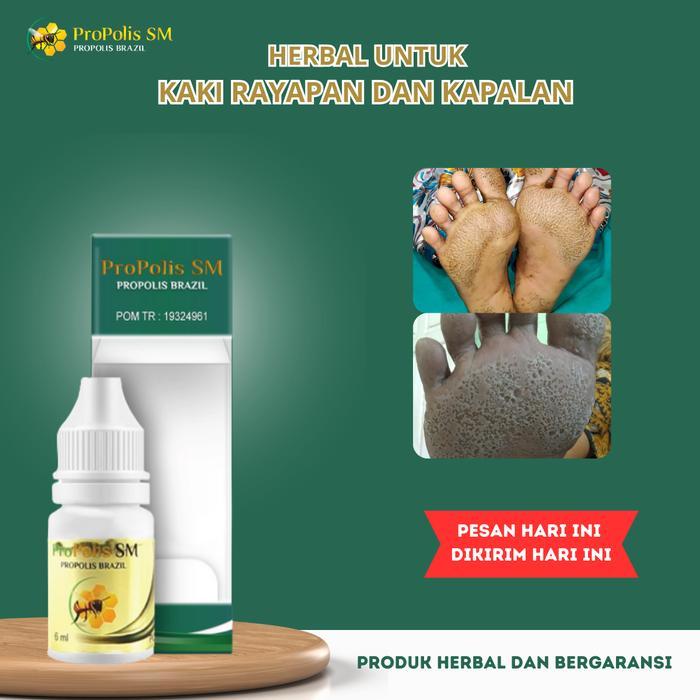 Cairan tetes untuk kaki kapalan, Kaki Rapayan Bolong Bolong, Gatal Kaki Berjamur, kaki kering