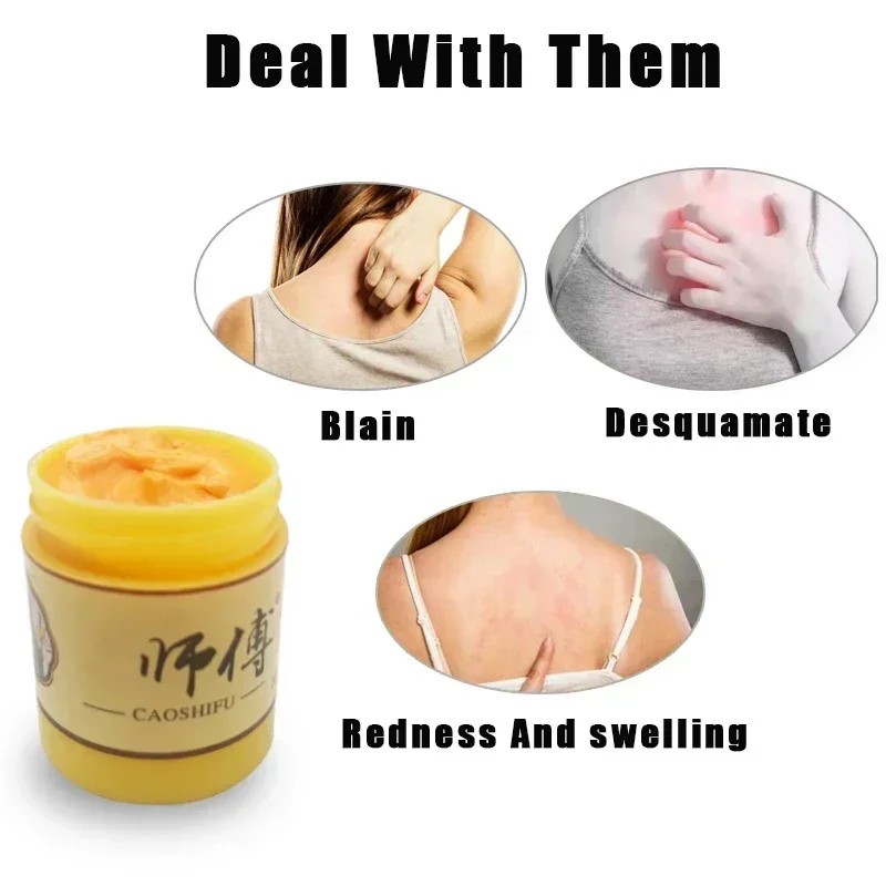 Skin Psoriasis Cream Dermatitis Eczematoid Eczema Psoriasis Cream Skin Care Cream