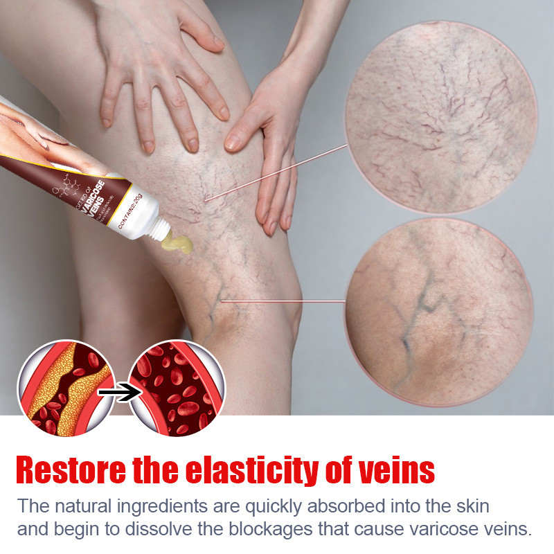 20g Varicose Vein Relief Cream Eliminate Vasculitis Phlebitis Spider Legs Treatment Soothing Relieve
