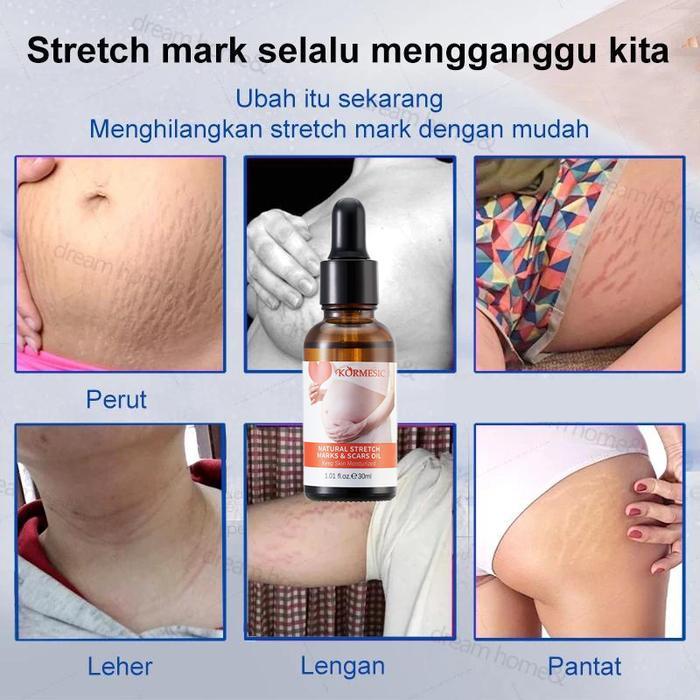 Stretch Mark Cream Stretch Mark Paling Ampuh 30Ml Rintik Stretch Mark Cream Krim Perawatan