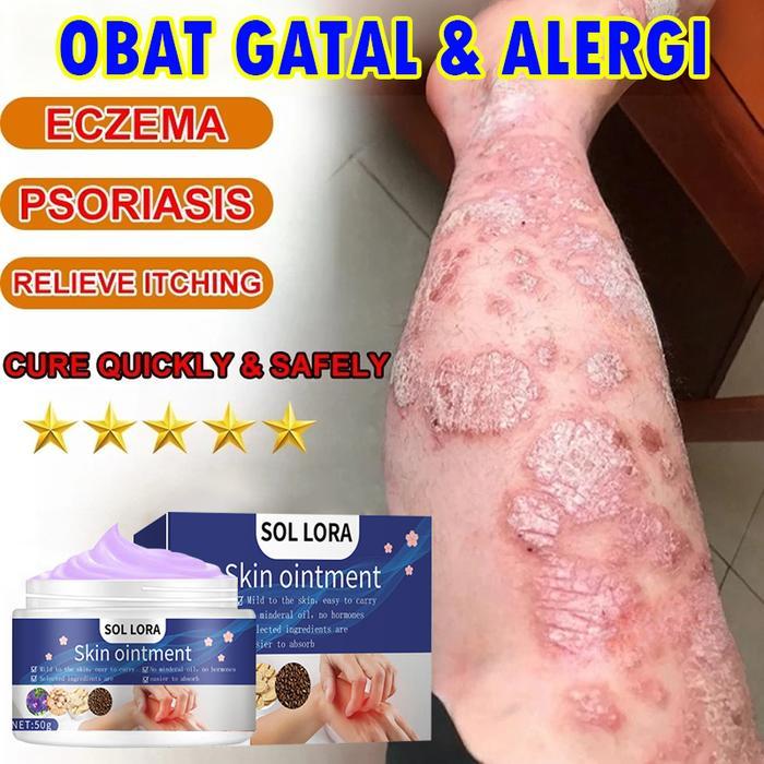Gatal/Krim Gatal Kulit Skin Soothing Cream Eksim Kering Dan Gatal Gatal Selangkangan Krim Original