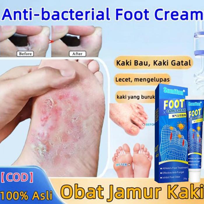 Obat Kaki Rayapan Telapak Kaki Bolong Pecah Pecah Korodok Kutu Air Rorombeheun Mata Ikan Kapalan